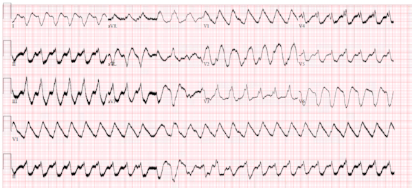 From Dr. Smith's ECG Blog, smaller than original.&nbsp; Click image to go to source.&nbsp; In accordance with Attribution-NonCommercial 4.0 International (CC BY-NC 4.0).