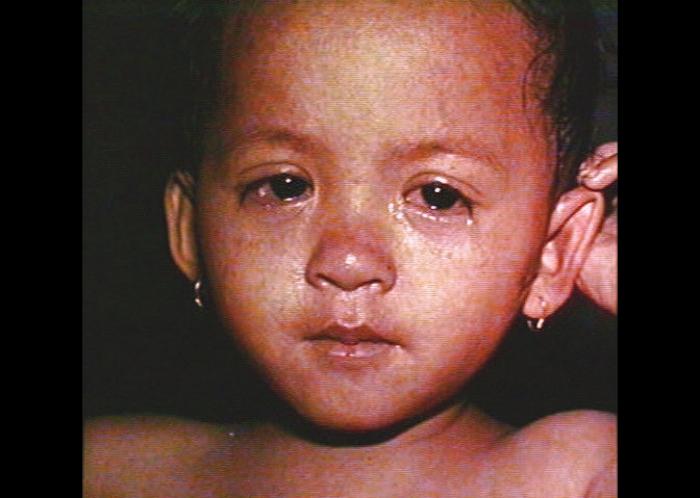 Image 1, Measles rash on face, conjunctivitis, mild coryza. From CDC.