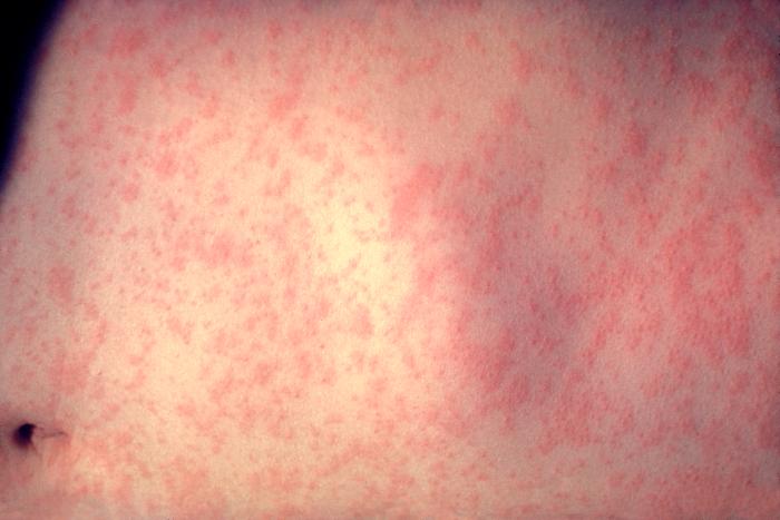 Image 4: Classic measles rash on abdomen on day 3 of eruption. From CDC.