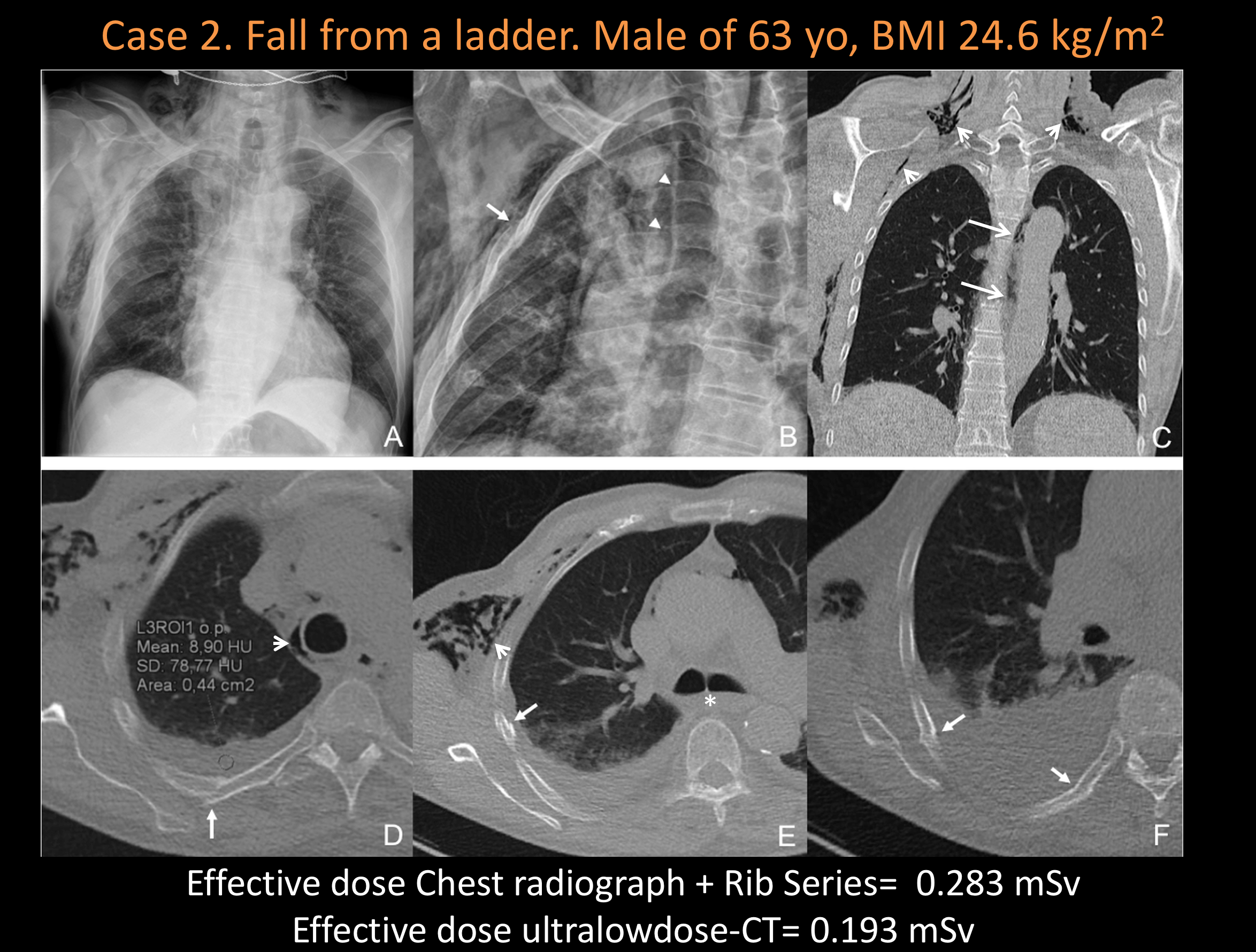 From cited article. “Chest radiographs AP view (A) and rib series (B). AP view demonstrates extensive subcutaneous emphysema and pneumomediastium (A). Fracture of the 3rd and 4th ribs were better visualized on rib series view (arrow) as well as pneu…