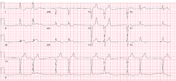 From Dr. Smith's ECG Blog, smaller than original.&nbsp; Click image to go to source.&nbsp; In accordance with Attribution-NonCommercial 4.0 International (CC BY-NC 4.0).
