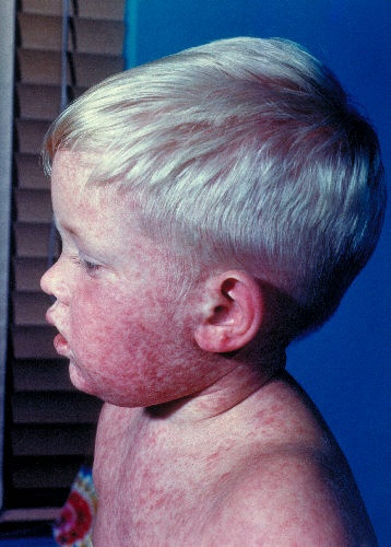 Image 3: Measles rash on face, spreading downward. From CDC.