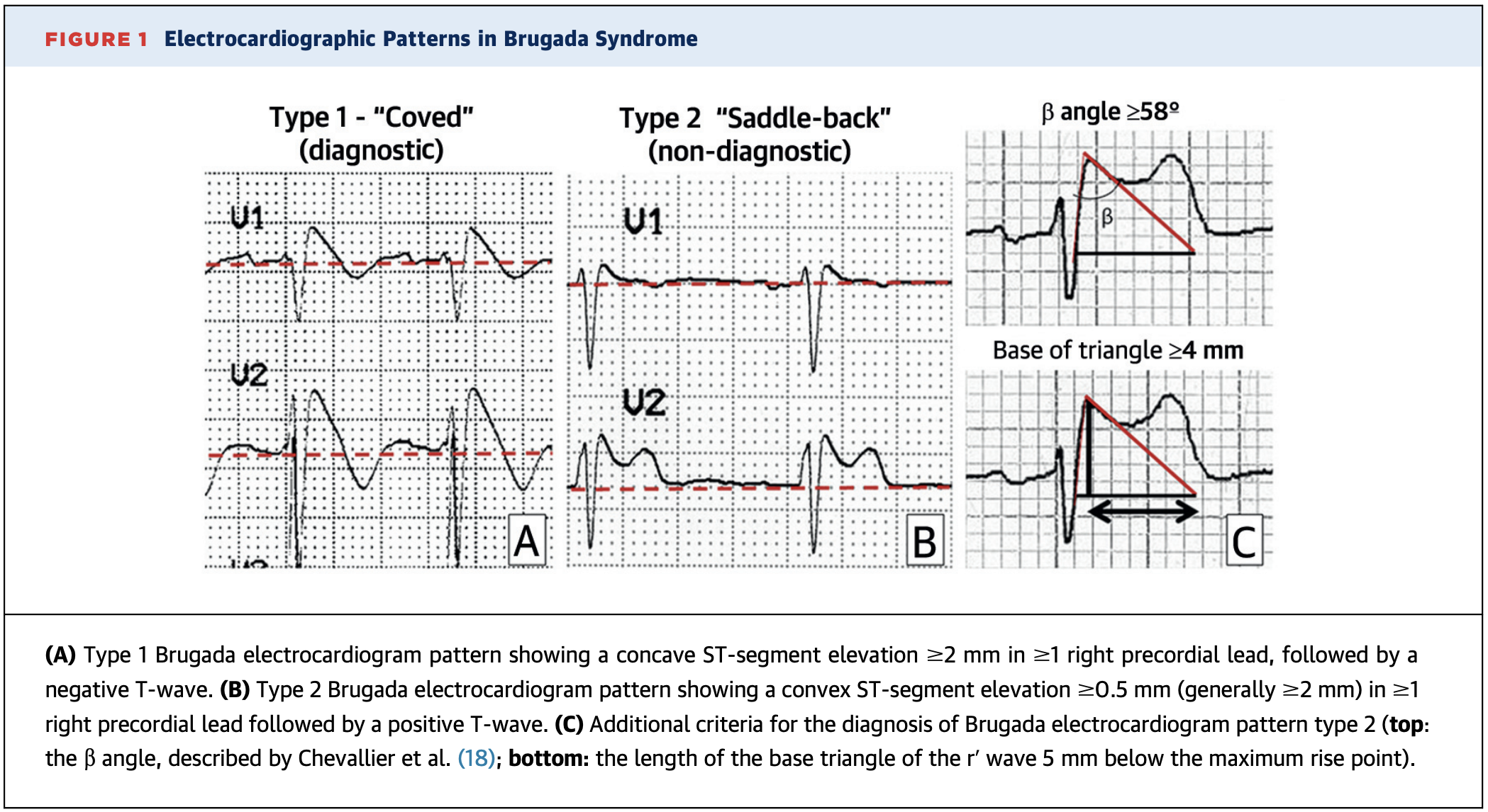 Asymptomatic Brugada – A Silent Danger – JournalFeed